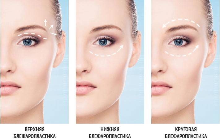 droga_blefaroplastika