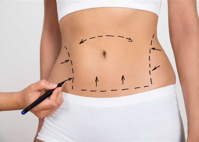 abdominoplastika