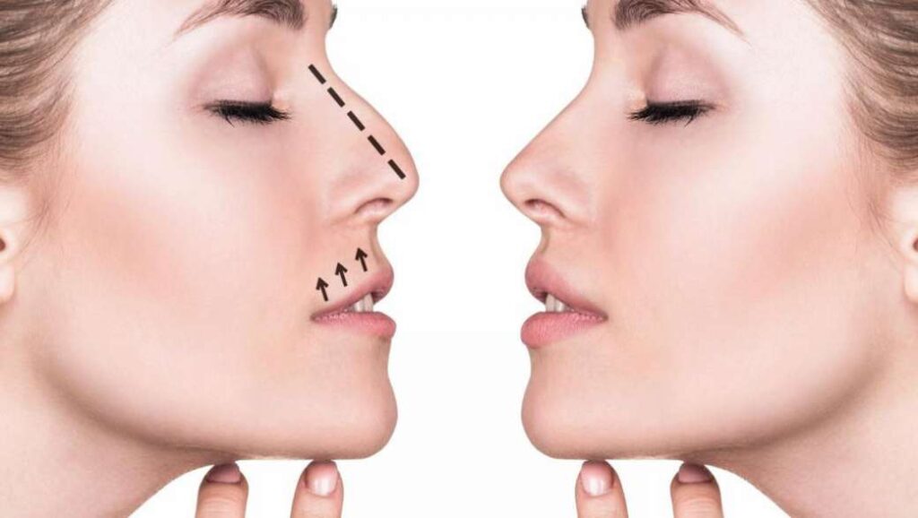 rinoplastika