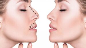 rinoplastika