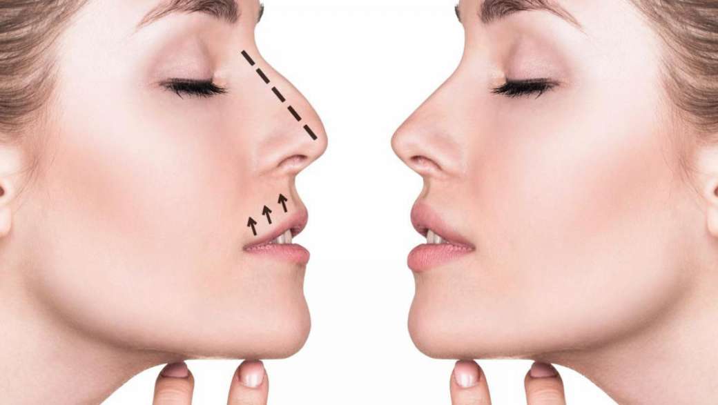 rinoplastika